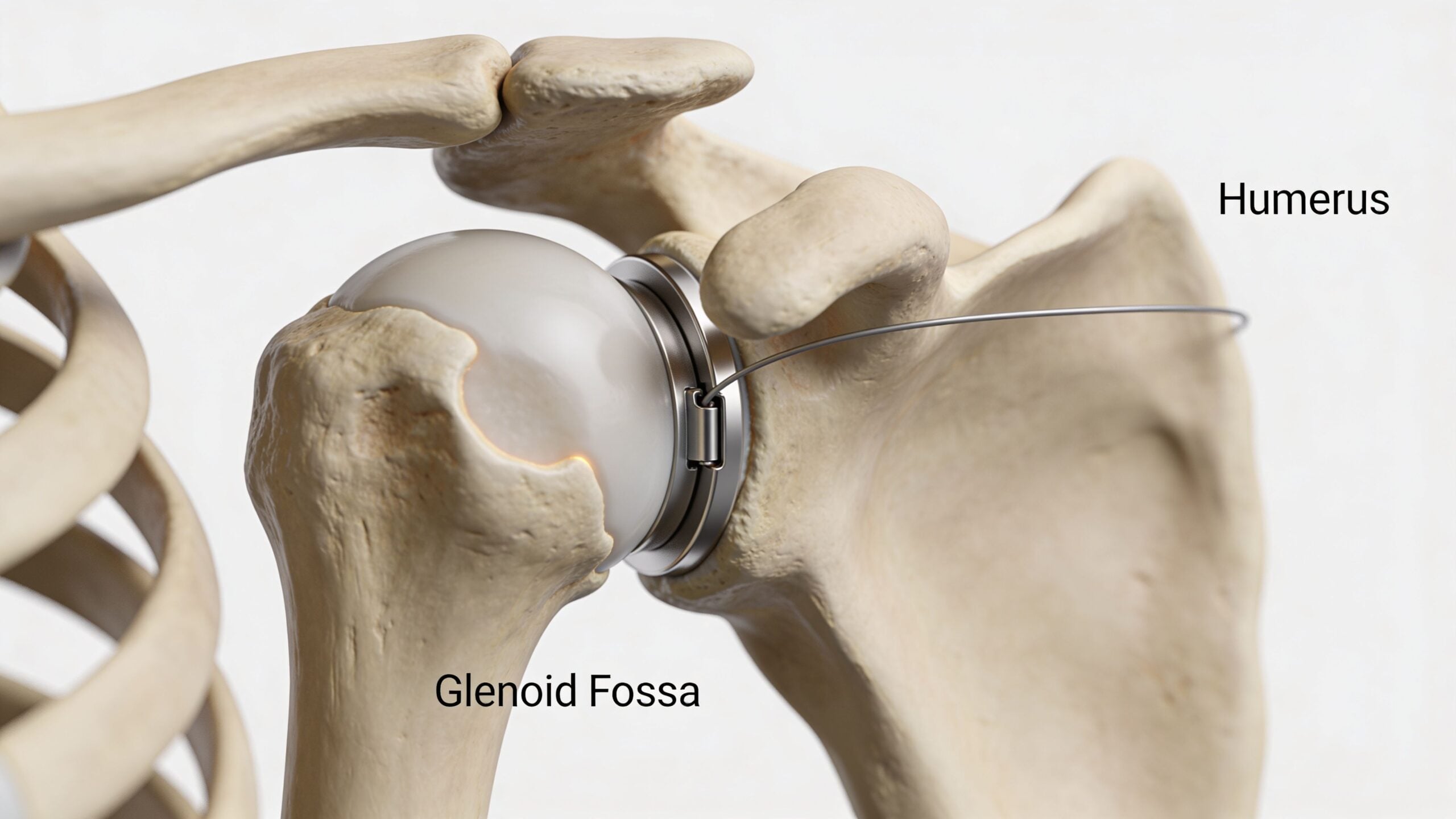 A detailed medical visualization of a shoulder joint implant attached to the glenoid fossa and humerus.