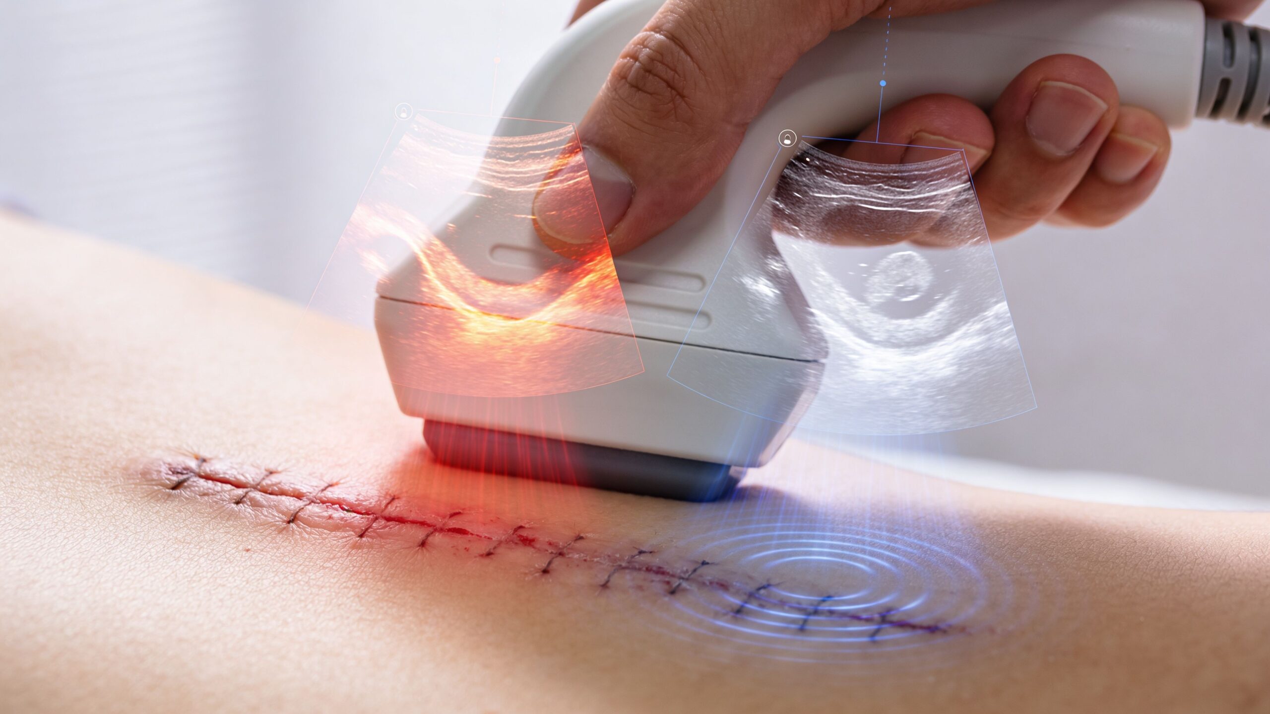 A medical professional uses an ultrasound probe on a healing surgical incision on a patient's skin.